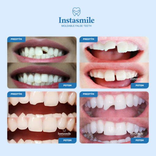INSTASMILE REPARAČNÝ KIT NA ZUBY - Image 2