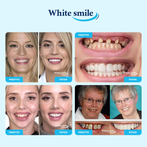 Realisticky vyzerajúce falošné zuby: WhiteSmile - Image 2